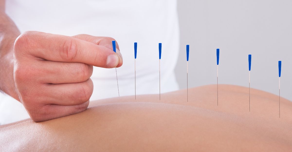 Acupuncture vs Dry Needling Know Top Differences and Benefits Setu