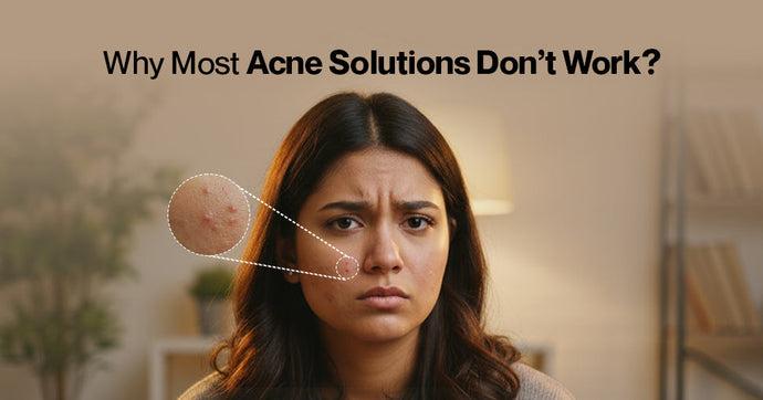 Why Most Acne Solutions Don't Work (and What Actually Does)