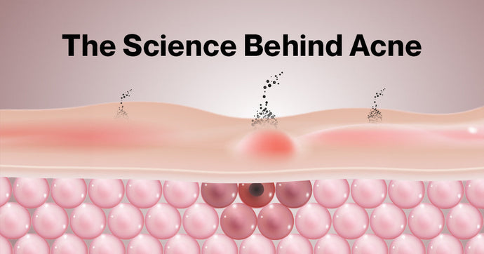 The Science Behind Acne: Causes, Myths & What Actually Works