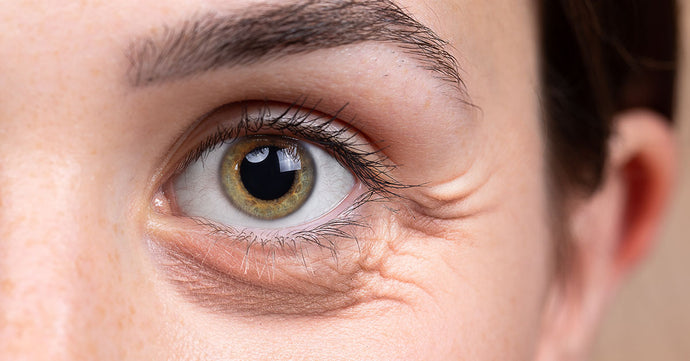 Home Remedies for Swelling Eyes