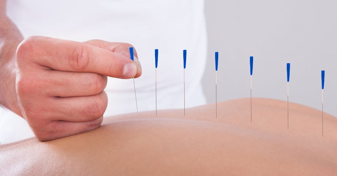 Is Acupuncture Actually Better Than Dry Needling?