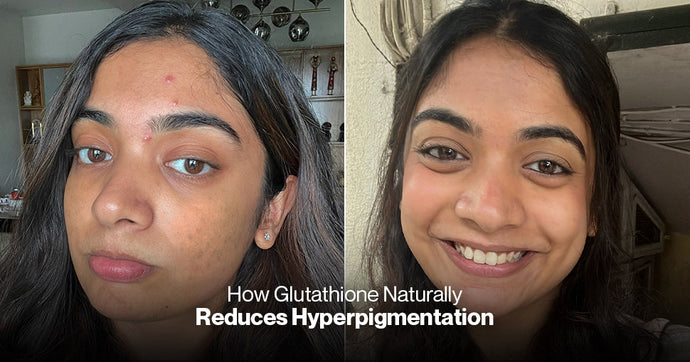 Brightening from Within: How Glutathione Naturally Reduces Hyperpigmentation