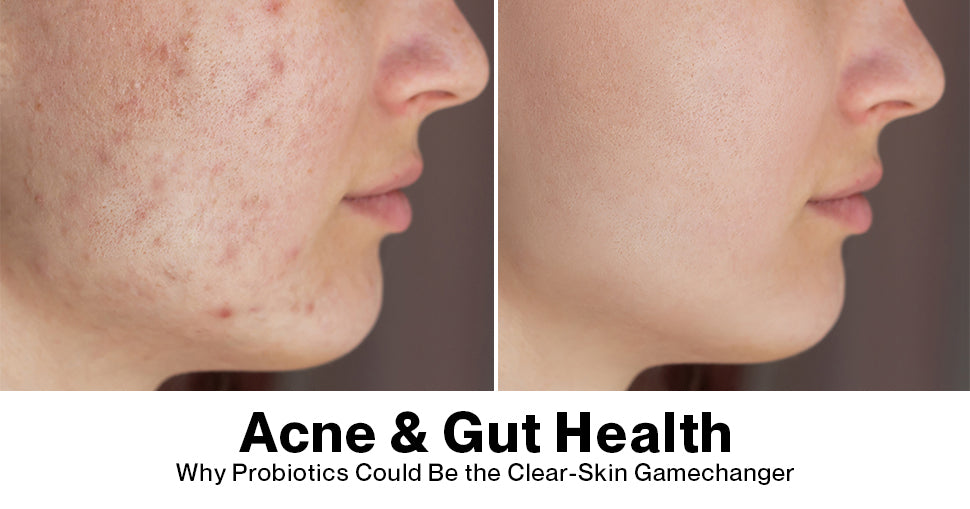 Why Most Acne Solutions Don't Work (and What Actually Does) Setu Nutrition Why Most Acne Solutions Don't Work (and What Actually Does) Setu Nutrition