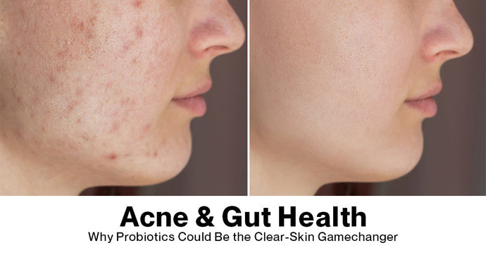 Acne and Gut Health: Why Probiotics Could Be the Clear-Skin Gamechanger
