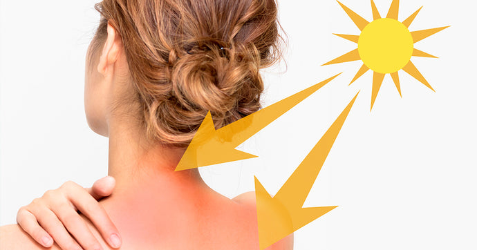 Here's why you must not take sunburns lightly